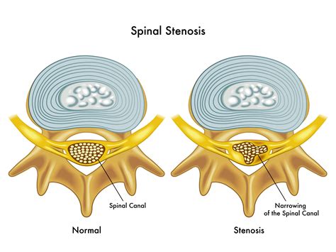 Spinal stenosis 醫學 中文